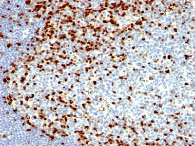 Monoclonal Antibody to ZAP70 (Chronic Lymphocytic Leukemia Marker)(Clone : SPM362)